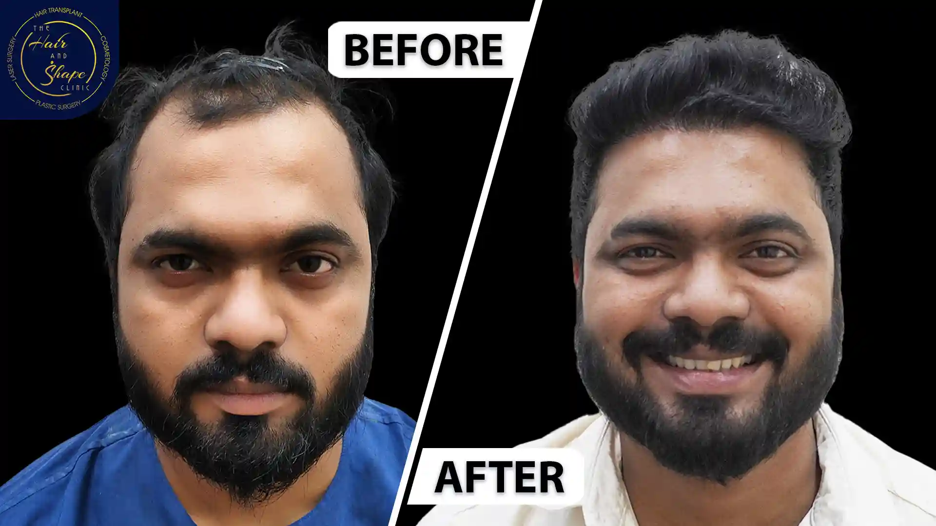 Hair Transplant result5